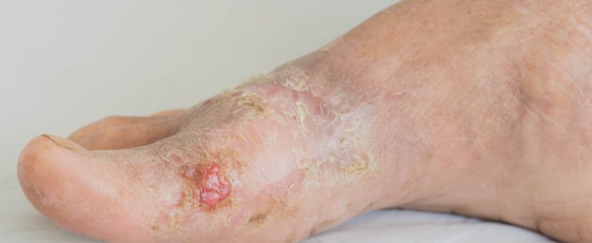 diabetischer-fuss-o02x8ahyblvi97lkc4stg5frcvxgkb9vbajbfg8b3g